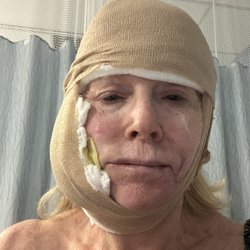 James A. Heinrich, MD FACS - Immediately Post excision surgery.... Pretty scary looking but got clear borders!!!