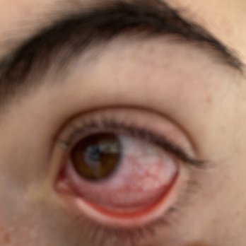 Amazing Lash Studio - eye after removal - Eyelash Service Near Me - Chesterfield, Missouri Amazing Lash Studio - eye after removal - Eyelash Service Near Me - Chesterfield, Missouri