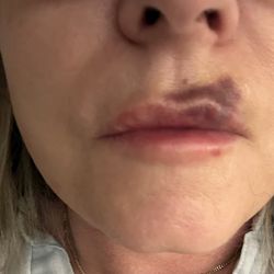 Serenity Dermatology - Day 5 after LaserAway Woodlands lip filler procedure