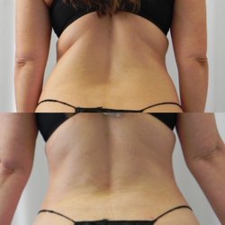 Institute for Beauty, Wellness & Regenerative Medicine - Liposuction