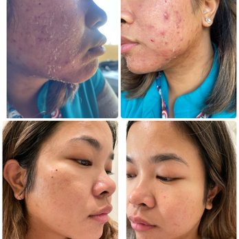 Gravitas Medspa - Top: March 2021  Bottom: Aug 2021 - Permanent Makeup Near Me - Beverly Hills, California