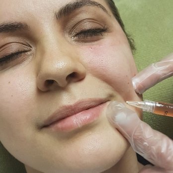 Absolute Medi Spa - PRP plasma rejuvenation. - Medical Spas Near Me - Mississauga, Ontario Absolute Medi Spa - PRP plasma rejuvenation. - Medical Spas Near Me - Mississauga, Ontario