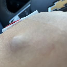 Swollen site of blood draw Swollen site of blood draw