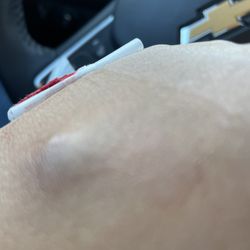 LabCorp - Swollen site of blood draw