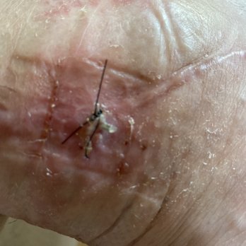 Seaview Orthopaedics - This is the lead that continued to pop out of my incision over and over. 4 times to be exact. - Orthopedists Near Me - Brick, New Jersey Seaview Orthopaedics - This is the lead that continued to pop out of my incision over and over. 4 times to be exact. - Orthopedists Near Me - Brick, New Jersey