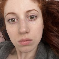 B. Aviva Preminger, MD - A week after IPL, same amount of makeup, but yes lighting is a little more flattering. Still a big difference!