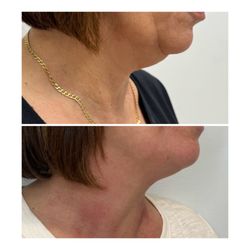 Good Body Recovery - Skin Tightening