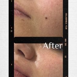 The Waxing Corner & Spa - EXOSOMAS TREATMENT