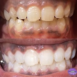 Kalassygems - 60 min Laser Teeth Whitening session 3 (20min) sessions for the best results.