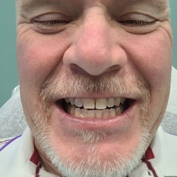 Naturally White Teeth Whitening - Finished first treatment. About 8 shades better. - Teeth Whitening Near Me - Houston, Texas Naturally White Teeth Whitening - Finished first treatment. About 8 shades better. - Teeth Whitening Near Me - Houston, Texas