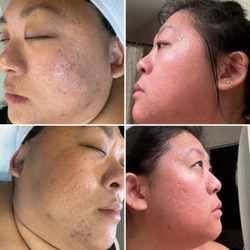 Nacre Beauty - The left are photos before the microchanneling facial. The right side are photos taken after, later that day!