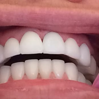Vigen Alikhanian, DDS - Another successful full mouth restoration with Zirconia crowns - General Dentistry Near Me - Burbank, California Vigen Alikhanian, DDS - Another successful full mouth restoration with Zirconia crowns - General Dentistry Near Me - Burbank, California