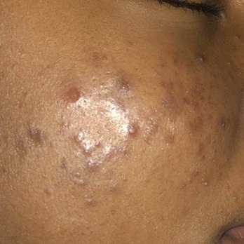 Tina Fermano, PA - Before - Skin Care Near Me - Hackensack, New Jersey Tina Fermano, PA - Before - Skin Care Near Me - Hackensack, New Jersey