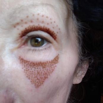 FACE - 1 day after FACE treatment - Medical Spas Near Me - Oakland, California