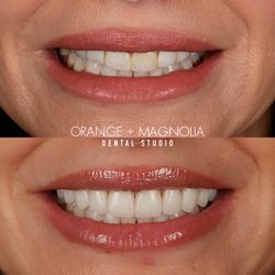Orange and Magnolia Dental Studio - 10 porcelain Veneers that are bright, natural, and give balance to the smile by Dr. Joyce Kahng
