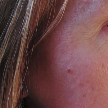 Proderma Acne Treatment Systems for Teens - After - Acne Treatment Near Me - San Clemente, California Proderma Acne Treatment Systems for Teens - After - Acne Treatment Near Me - San Clemente, California