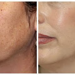 Paradise Med Spas of Texas - Diamond Tip Microdermabrasion