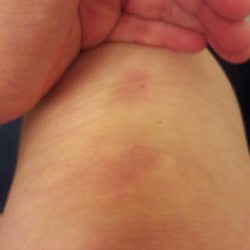 DART Police Department - Another one of my injuries.