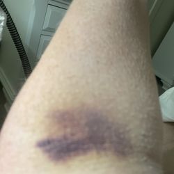 Quest Diagnostics - My bruised vein