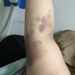 BioLife Plasma Services - Bruises