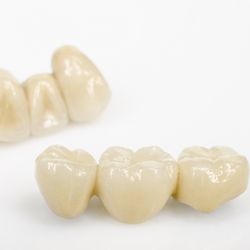 Layered Zirconia Bridge