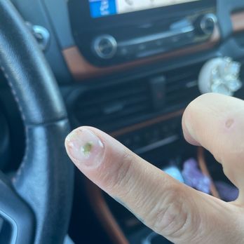 Pretty Nails - Fungus - Nail Salons Near Me - Denver, Colorado Pretty Nails - Fungus - Nail Salons Near Me - Denver, Colorado