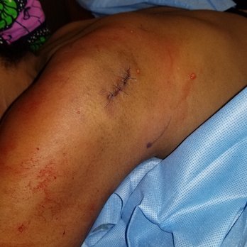 Mountcastle Plastic Surgery and Vein Institute - After lipoma removal. - Medical Spas Near Me - Ashburn, Virginia