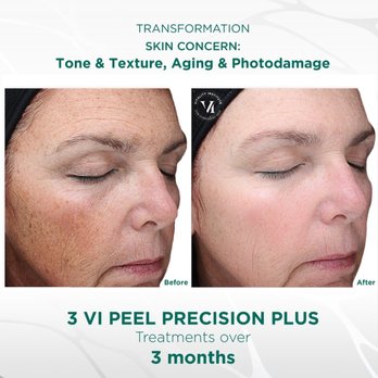 Hyperpigmentation & Melasma Treatment Center - Medical Spas Near Me - New York, New York Hyperpigmentation & Melasma Treatment Center - Medical Spas Near Me - New York, New York