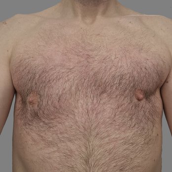 Alexander Ereso, MD FACS - Asymmetry - Cosmetic Surgeons Near Me - Mountain View, California