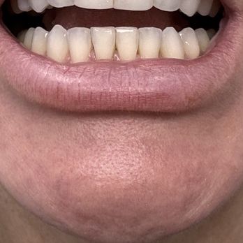 Hollywood Perfect Smile - After a year of braces for my bite - Cosmetic Dentists Near Me - Hollywood, Florida