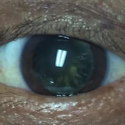 Mom's left eye after dilatation beforesurgery! Mom's left eye after dilatation beforesurgery!
