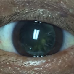 Med-Laser Surgical Center - Mom's left eye after dilatation beforesurgery!