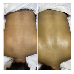 Sassi Senia Aesthetics - Brightening back treatment