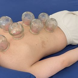 Getting cupped Getting cupped