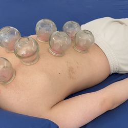 Total Harmony Health - Getting cupped