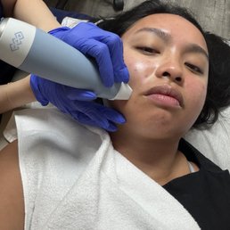 exion rf needling exion rf needling