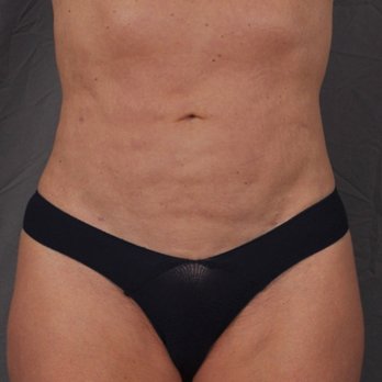 Infini Cosmetic Associates - After - Cosmetic Surgeons Near Me - Scottsdale, Arizona