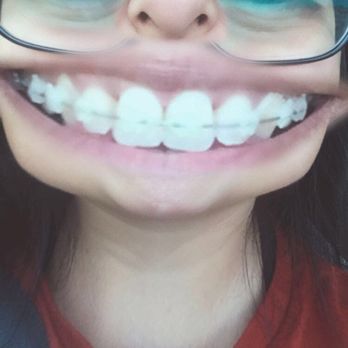 Steven D Gilbertson, DDS - 5 months into treatment . 3o years old with clear braces . The gap is gone ! But got 13 more months to go . Getting Wedding ready nov 2019! - Orthodontists Near Me - Newhall, California Steven D Gilbertson, DDS - 5 months into treatment . 3o years old with clear braces . The gap is gone ! But got 13 more months to go . Getting Wedding ready nov 2019! - Orthodontists Near Me - Newhall, California