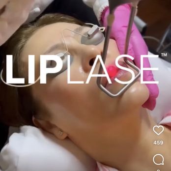 New Age Laser Clinic - Looking for a treatment that can plump your lips without needles? LipLase is the all natural pout plumping and defining treatment that will - Skin Care Near Me - Hamilton, Ontario New Age Laser Clinic - Looking for a treatment that can plump your lips without needles? LipLase is the all natural pout plumping and defining treatment that will - Skin Care Near Me - Hamilton, Ontario