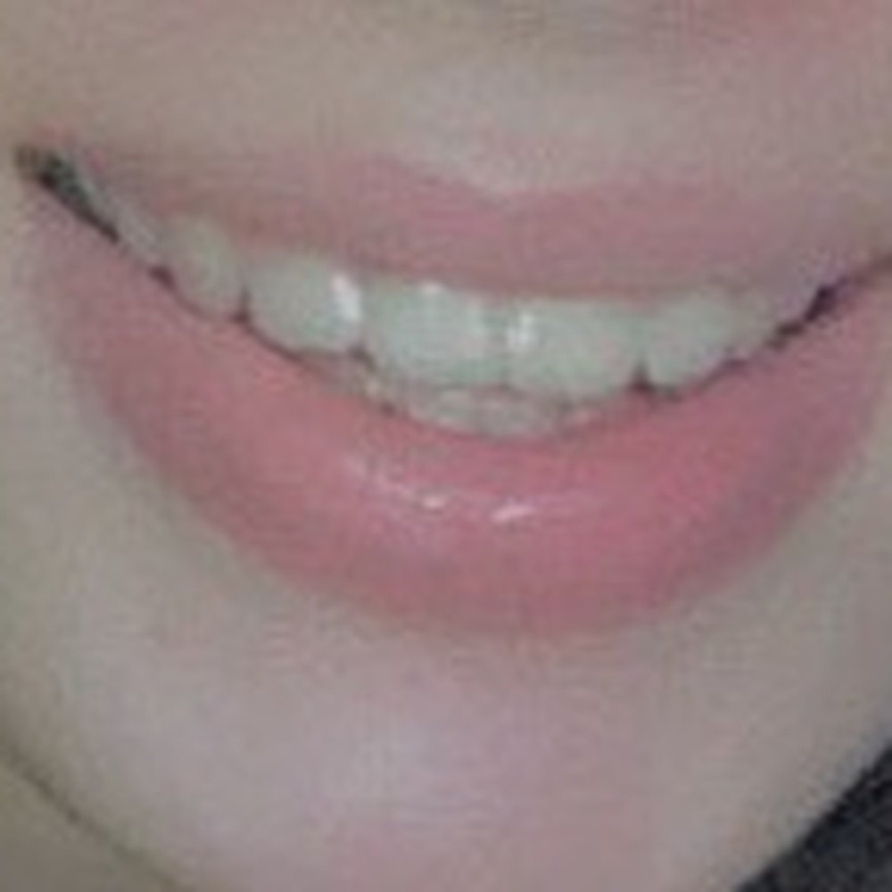 Access Orthodontics - After results - Orthodontists Near Me - Weymouth, Massachusetts Access Orthodontics - After results - Orthodontists Near Me - Weymouth, Massachusetts