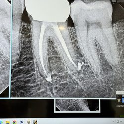 After treatment, Dr. Scott reviews the work done with x-rays to ensure he has achieved the best results possible.
