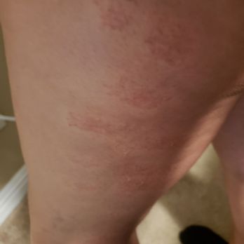 Dolce Bella Spa - Burns on my leg. - Day Spas Near Me - Tijuana, BCN Dolce Bella Spa - Burns on my leg. - Day Spas Near Me - Tijuana, BCN