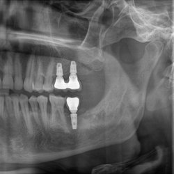 Oxy Dental - Another Successful Implant Surgery From A to Z