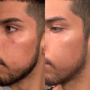 Glowdega - Majestic No. 8 before and after - Skin Care Near Me - Oakland, California Glowdega - Majestic No. 8 before and after - Skin Care Near Me - Oakland, California