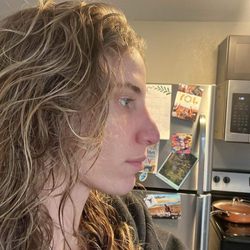 Capraro Plastic Surgery & Regenerative Aesthetics - Hideous shape 2 years later