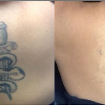 Laser Goddess - 5 Picoway Laser Treatments on a 10 year old tattoo - Laser Hair Removal Near Me - Bayside, New York