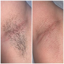 Waxstrology - Underarm wax - before/after