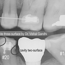 Westgate Smiles - Actual cavity two-surface circled lower right #20.  Composite three-surface filing circled upper left #20. Leaving the cavity left to decay
