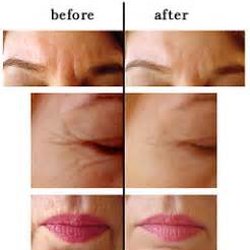 Monte Sano Acupuncture & Naturopathy - The Monte Sano Clinic provides face-lift acupuncture to help eliminate facial wrinkles and fine lines. Better than Botox!