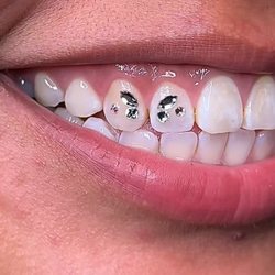 Teeth Blingy - The butterfly